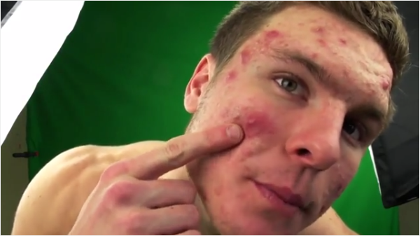 La increíble transformación de joven para superar fuerte caso de acné: este es su secreto