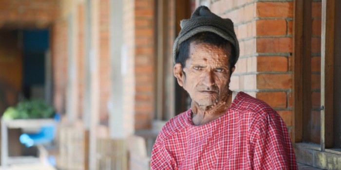 La historia del hombre que vivió 47 años con un tumor de 12 kilos en su rostro