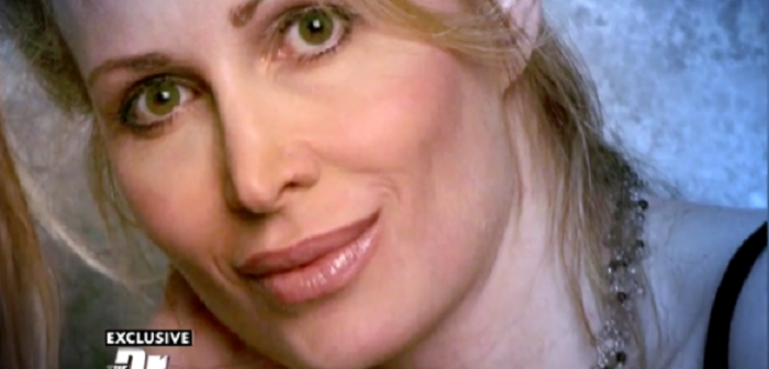 Mujer quedó con el rostro desfigurado tras complicaciones con rellenos cutáneos