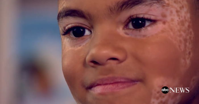 Rowdy: el particular perro que cambió la vida de un niño con vitiligo