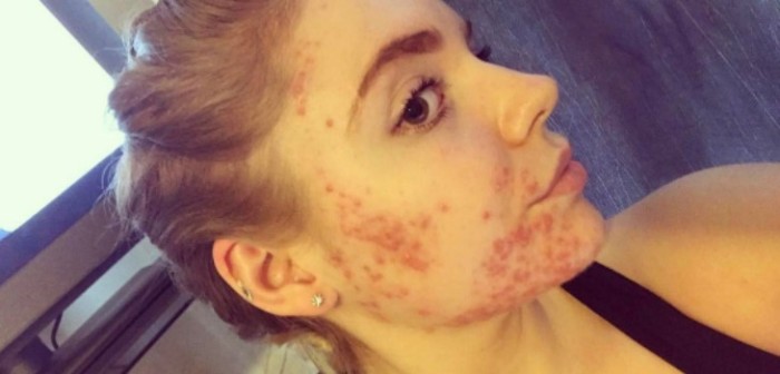 Increíble antes y después de joven que sufría grave acné: es una inspiración para muchas