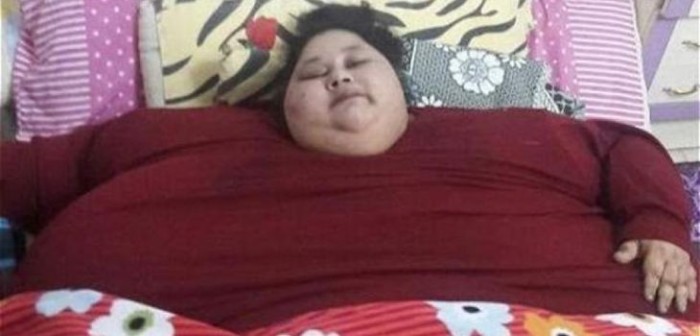 La mujer más obesa del mundo pierde 250 kg tras operación en India