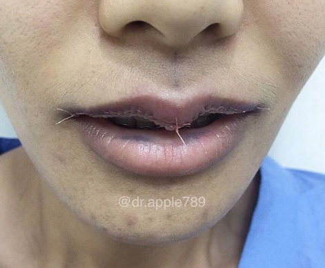 mor.ple_surgery | Instagram