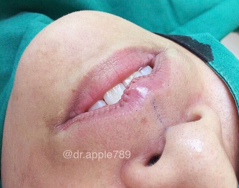 mor.ple_surgery | Instagram