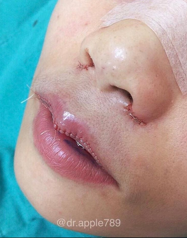 mor.ple_surgery | Instagram