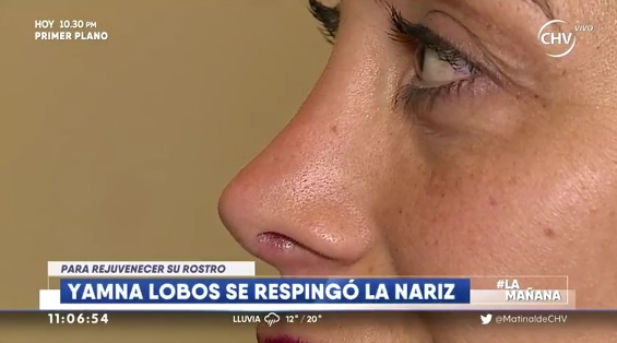 Nariz de Yamna Lobos después de la intervención | CHV