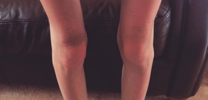 Pasó de ser una joven anoréxica que pesaba solo 32 kilos a una bailarina de pole dance