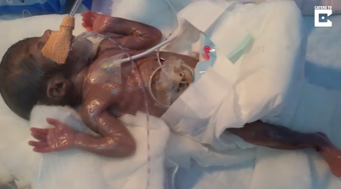 Así luce el bebé 'más pequeño del mundo' sometido a una cirugía al corazón