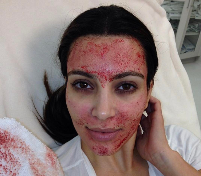 Vampiro facial: el sangriento tratamiento que se populariza entre las celebridades