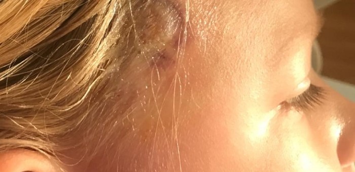 Madre advierte en Facebook sobre extraños síntomas tras picadura de garrapata