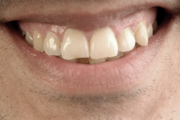 Caída de dientes: el peligroso efecto secundario que podría provocar el estrés