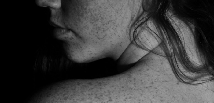 Brutal ataque de celos: joven británica derramó ácido a compañera que salía con su ex