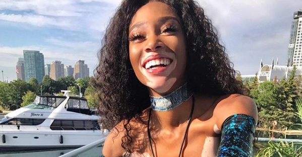 Modelo con vitiligo se desnuda para entregar potente mensaje sobre la belleza