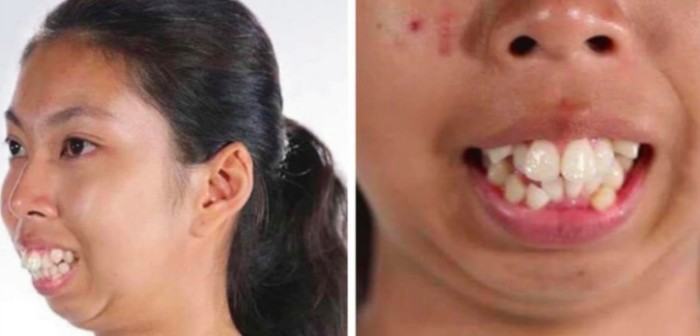 Tailandesa pasó de ser la ‘patito feo’ a una bella joven tras operar su mandíbula