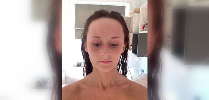 Mujer gastó más de $5 millones en cirugía para reducir su frente: se cansó del bullying