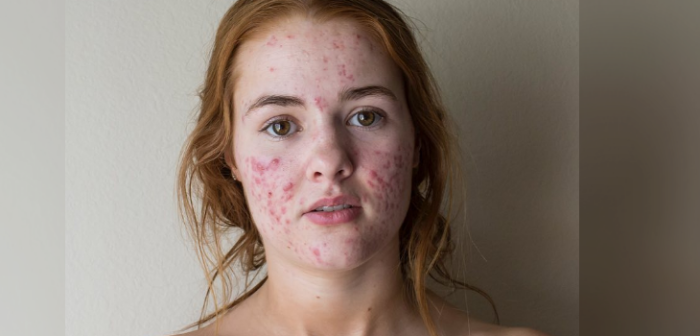 Joven comparte motivadora reflexión tras superar agresivo cuadro de acné