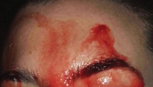 Investigadores examinan extraño caso de joven que transpira sangre