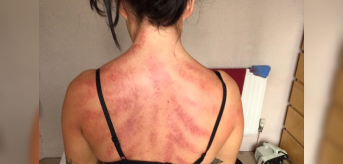 Así terminó una estilista por pasar muchas horas de pie en su trabajo