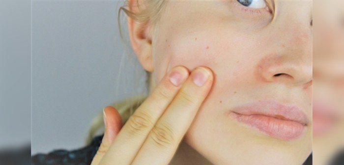 ¿Tienes rosácea? Sigue estos 5 (y simples) consejos que te ayudarán a controlarla