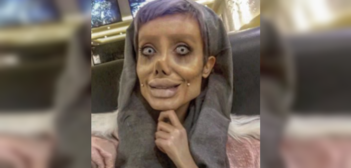 Joven iraní habló sobre sus '50 cirugías' para parecerse a Angelina Jolie