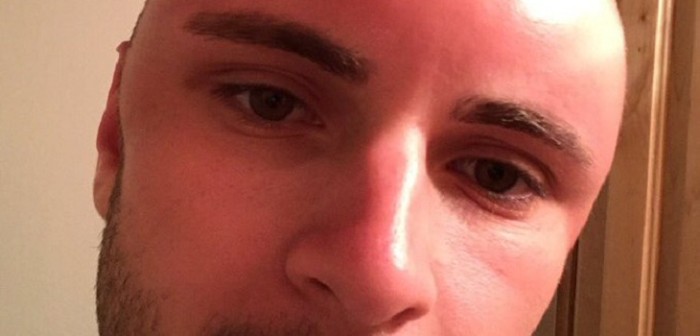 Joven mostró las consecuencias que le dejó exponerse al sol tras rapar su cabeza
