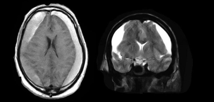 ¿Qué es un hematoma subdural? La enfermedad poco conocida que aquejó al expresidente Frei