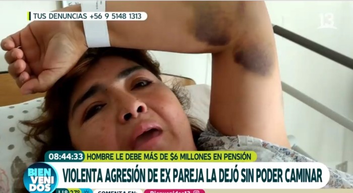 Quedó postrada: el desolador relato de mujer que fue agredida por su expareja