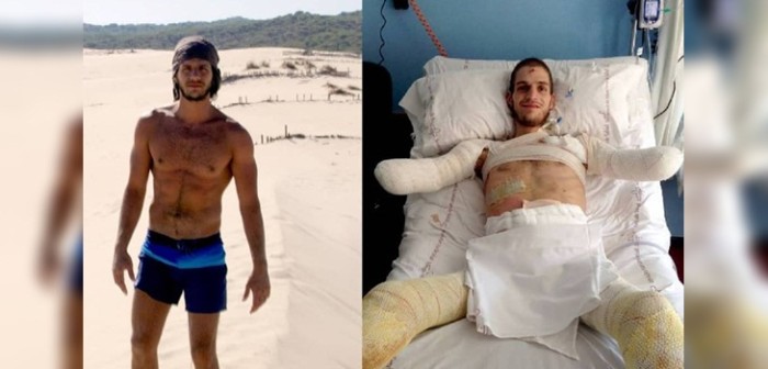 Potente historia: enfermedad fulminante dejó a joven deportista sin piernas ni brazos