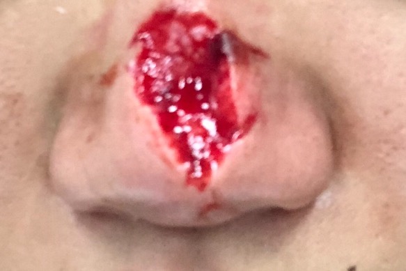 Así quedó la nariz de Tatiana | GoFundMe