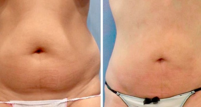 ¿Deseas una? Las 3 cirugías estéticas más solicitadas por chilenos entre 20 y 35 años