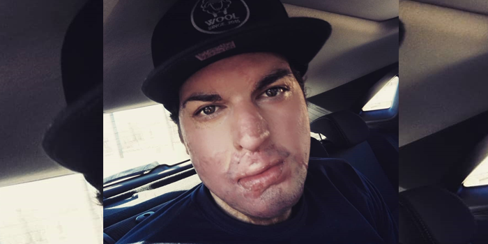 Ignacio Lastra tuvo que dejar las pesas: su piel aún no está recuperada al 100%