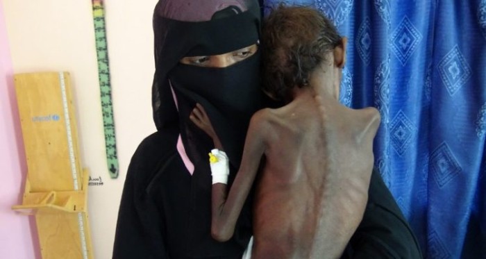 Los impactantes registros de madre yemení junto a su hijo de 5 años que pesa sólo 5 kilos