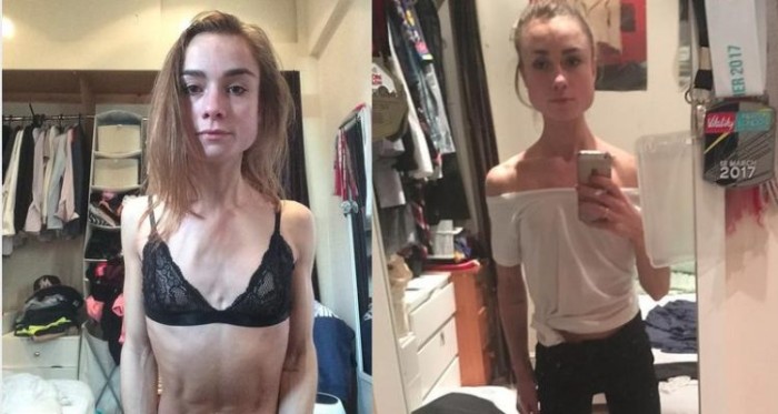 Bailarina sufrió sorprendente cambio tras vencer la anorexia: llegó a pesar 35 kilos