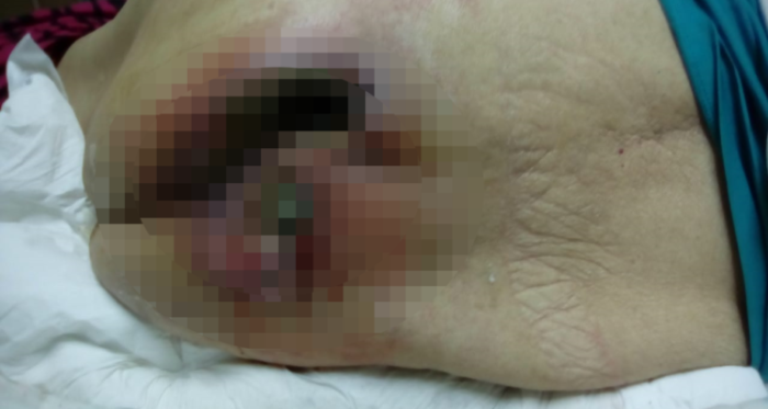 Mujer de 81 años de Valdivia sufre por profunda herida en su espalda: podría morir