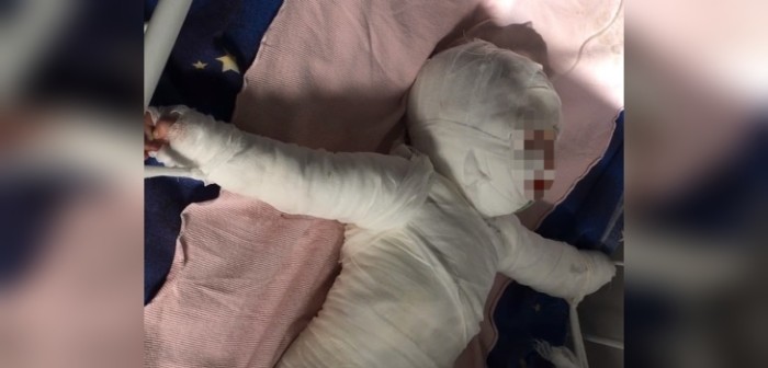 Dramático caso de bebé que cayó a balde con agua hirviendo conmociona a Ucrania: lucha por su vida