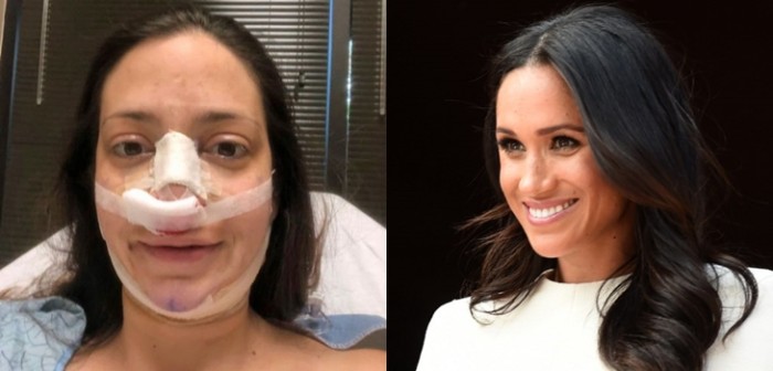 Mujer gastó casi 15 millones en cirugías para parecerse a Meghan Markle: estos son los resultados