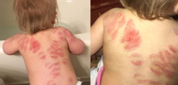 Madre encontró a su bebé llena de mordeduras tras recogerla de la guardería: su denuncia es viral