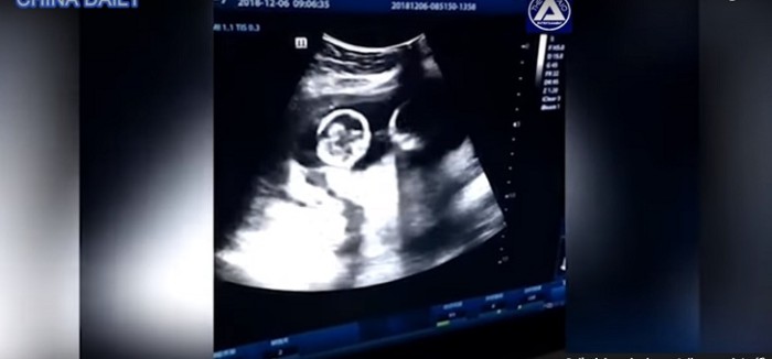 Estudios revelan que salud intestinal de las mamás afectaría el desarrollo cerebral de sus bebés