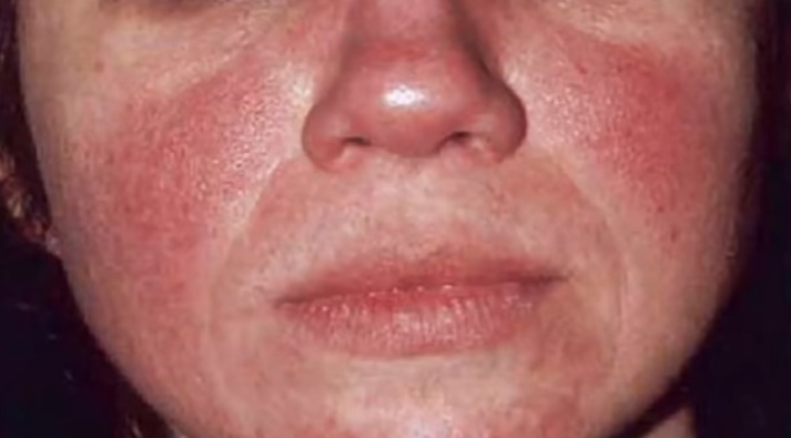 Especialista responde a las 6 preguntas más frecuentes sobre la rosácea