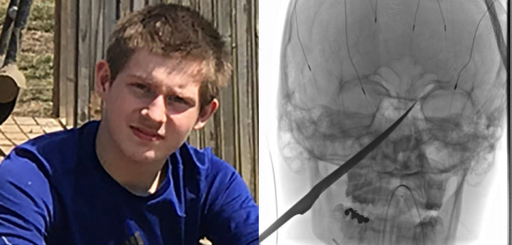 Joven se enterró cuchillo de 25 centímetros en la cabeza: lograron extraerlo tras exitosa operación