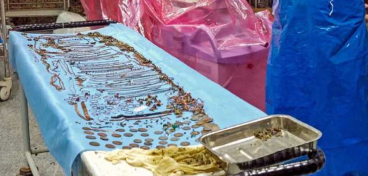 Mujer se sometió a delicada cirugía tras tragarse más de un kilo y medio de joyas: tenía 69 cadenas