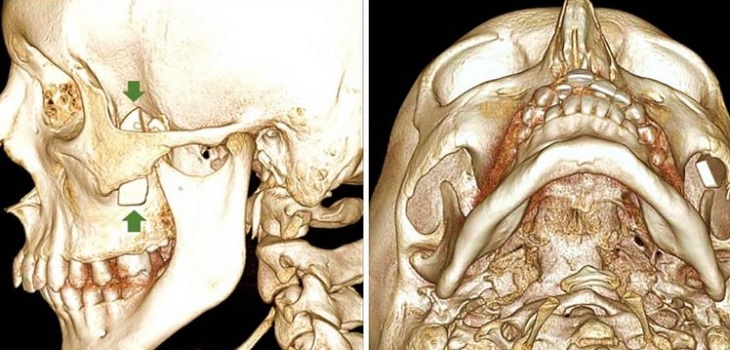 Tras un serio accidente joven vivió con un trozo de vidrio incrustado en la mejilla por un mes
