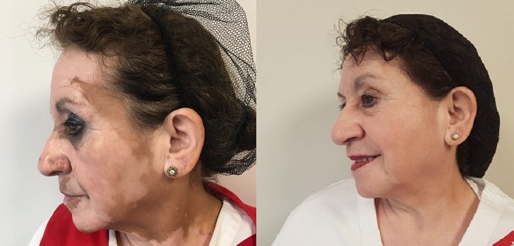 pacientes tratados por vitiligo