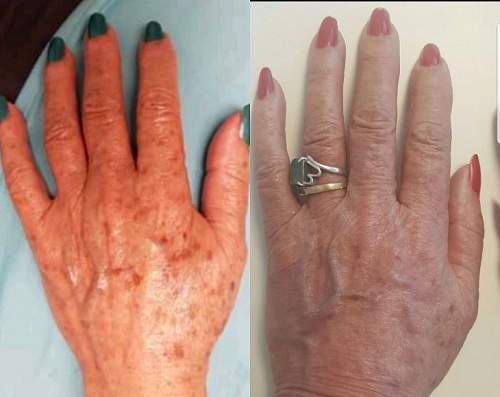 pacientes tratados por vitiligo