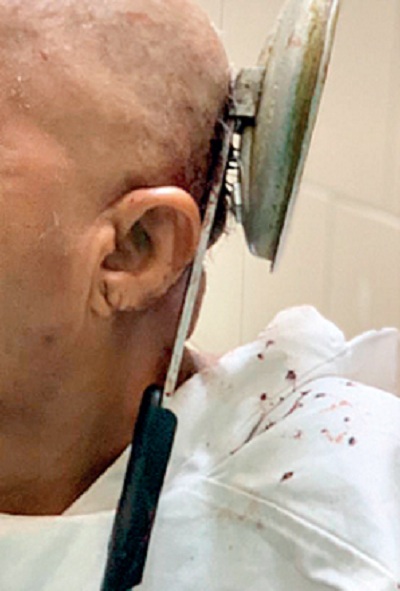 mujer india se incrusto tapa olla a presion craneo