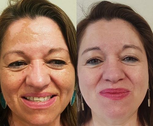 pacientes tratados por vitiligo