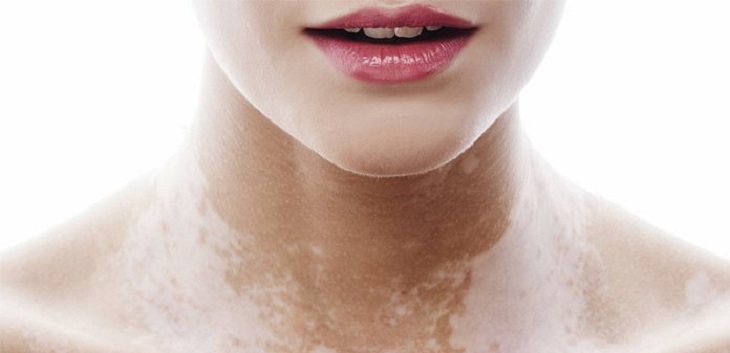 Vitiligo: el origen y tratamiento de la enfermedad que hace perder el color de la piel