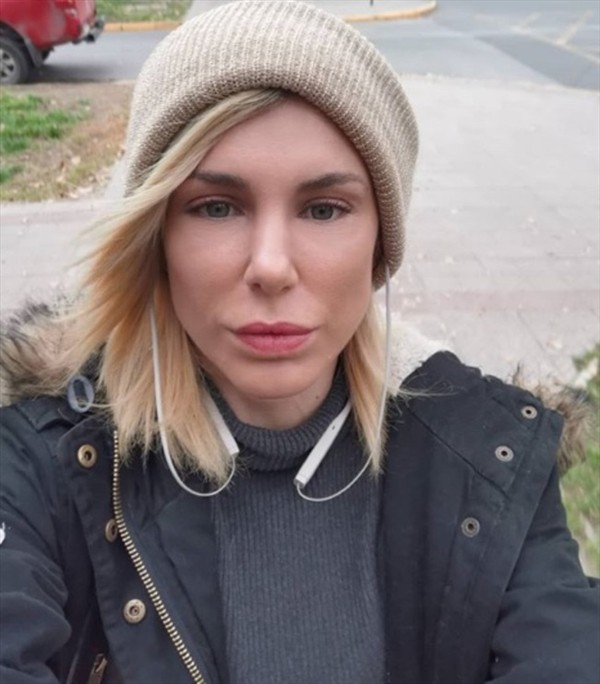  Rinoplastía de Wilma González