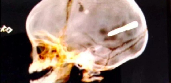 Trágica muerte de bebé de 10 meses en Brasil: recibió impacto de clavo de construcción en la cabeza