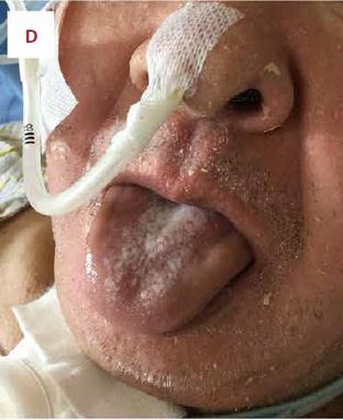 Lengua de hombre se tornó negra y le provocó 2 paros cardíacos 